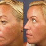 Hyperpigmentation Treatment