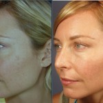 Sun Damaged skin treatments
