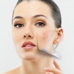 Treatments for Acne