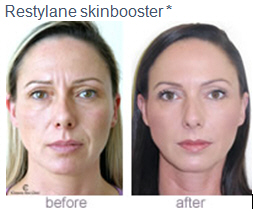 restylane-skin-boosters-before-after