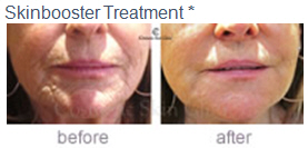 skin-booster-before-after