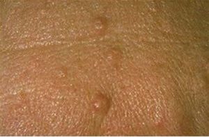 Sebaceous Hyperplasia Skin Treatments