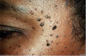 Dermatosa Papulosa Nigra Skin Treatments