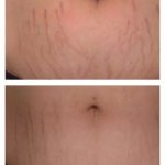 microneedling to remove scars
