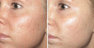 facial treatments before and after