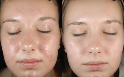 Dermaquest Skin Therapy Treatments